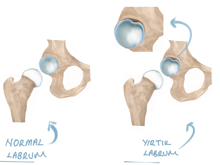 Kalça Labrum Yırtığı