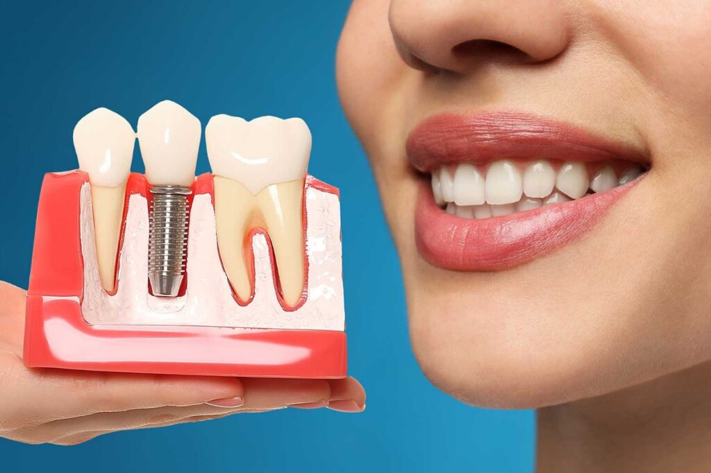 kadıköy dental implant